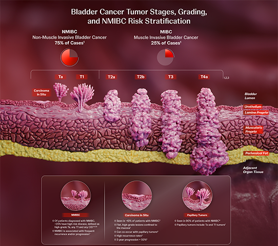 Bladder cancer tumor stages, grading, and NMIBC risk stratification thumbnail